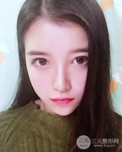 成都天使之翼金輝假體隆鼻案例前后對(duì)比圖分享~