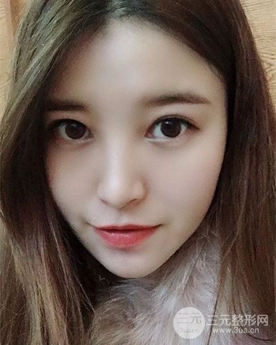 成都天使之翼金輝假體隆鼻案例前后對(duì)比圖分享~