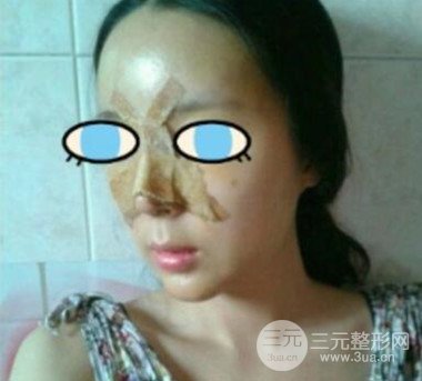 杭州華山連天美膨體隆鼻日記前后對比圖分享~