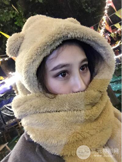 貴陽(yáng)麗都李觀龍隆鼻整形案例對(duì)照?qǐng)D一個(gè)月恢復(fù)過(guò)程分享