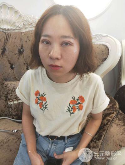 湘潭華美切開雙眼皮案例對照圖兩個月恢復過程心情日扎
