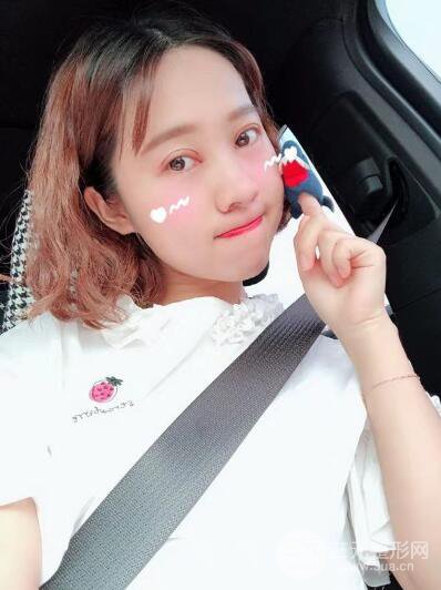 湘潭華美切開雙眼皮案例對照圖兩個月恢復過程心情日扎