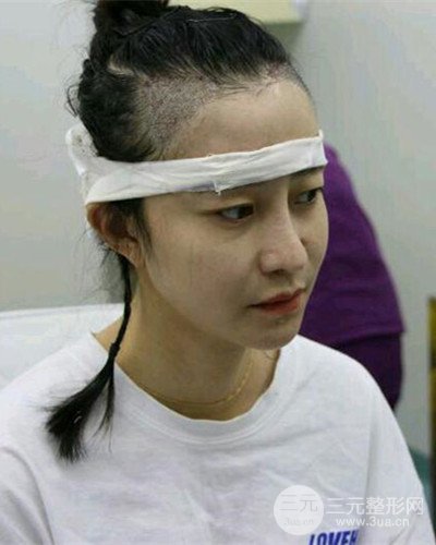 北京雍禾韓巖發(fā)際線種植手術(shù)半年了，分享前后果圖片~