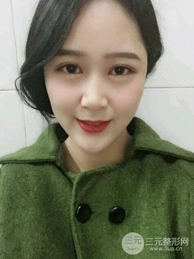 四川友誼李萍醫(yī)生假體墊下巴前后對比果圖片分享~