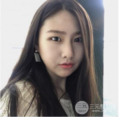 西安葉子魯禮新埋線雙眼皮案例對照圖!兩個月恢復心情小記