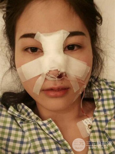 華人醫(yī)聯(lián)馬麗醫(yī)生膨體隆鼻日記分享