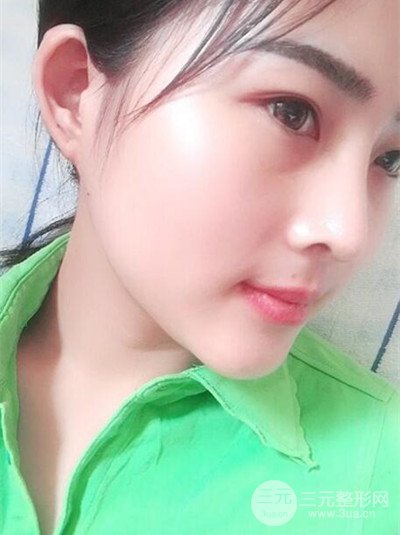 華人醫(yī)聯(lián)馬麗醫(yī)生膨體隆鼻日記分享