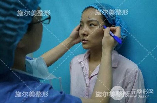 江蘇施爾美自體脂肪詳細(xì)部填充恢復(fù)記錄前后對比圖分享~