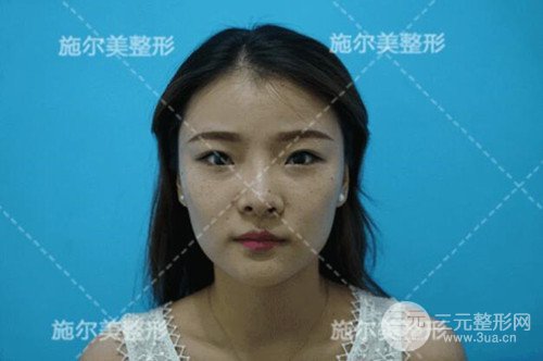 江蘇施爾美自體脂肪詳細(xì)部填充恢復(fù)記錄前后對比圖分享~