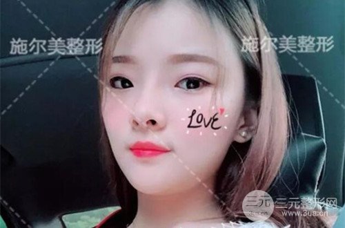 江蘇施爾美自體脂肪詳細(xì)部填充恢復(fù)記錄前后對比圖分享~