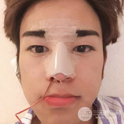 成都蜀尚蓉雅陳建華隆鼻整形前后對比照分享~