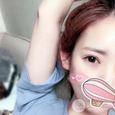 成都素美楊迪雙眼皮案例前后對(duì)比照分享~