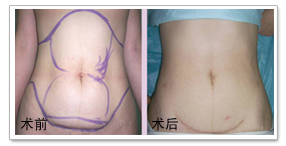 吸脂瘦身之脂肪抽吸整形 詳細(xì)吸脂塑身
