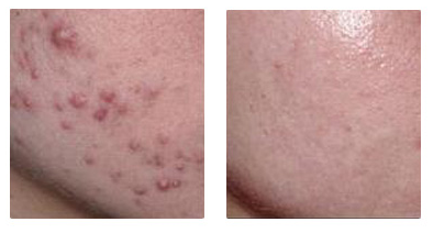 四川激光緩解痤瘡有什么優(yōu)勢(shì)