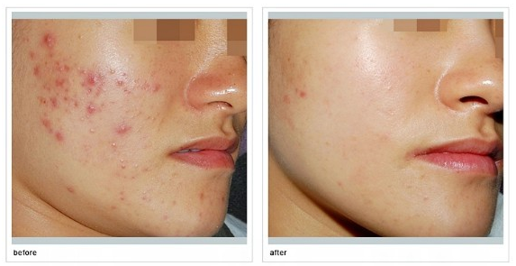 四川激光緩解痤瘡果怎么樣