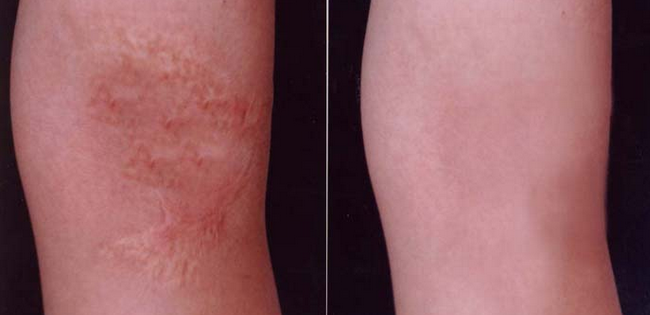 四川注射膠原蛋白祛疤的成好嗎