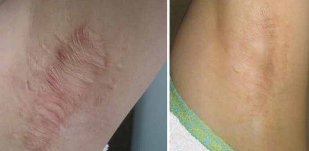 四川注射自體脂肪祛疤的成好嗎