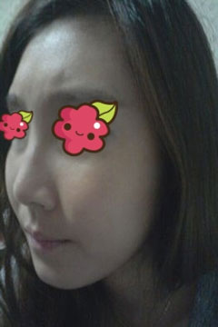 非手術(shù)隆鼻費(fèi)用一般需要多少錢,非手術(shù)隆鼻前的注意事項(xiàng)