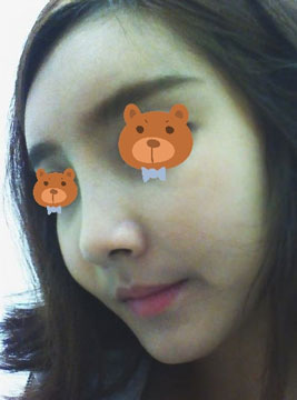 非手術(shù)隆鼻費(fèi)用一般需要多少錢,非手術(shù)隆鼻前的注意事項(xiàng)