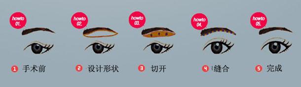 做切眉術(shù)降低風(fēng)險(xiǎn)嗎 切眉術(shù)風(fēng)險(xiǎn)大不大