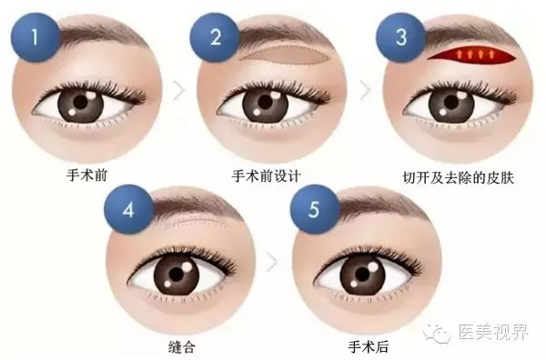 做切眉術(shù)降低風(fēng)險(xiǎn)嗎 切眉術(shù)風(fēng)險(xiǎn)大不大