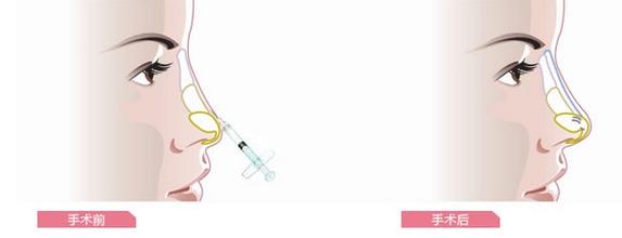 注射玻尿酸隆鼻前后應(yīng)注意什么