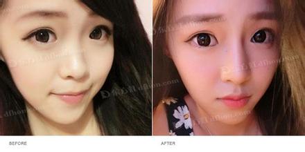 注射玻尿酸隆鼻前后應(yīng)注意什么