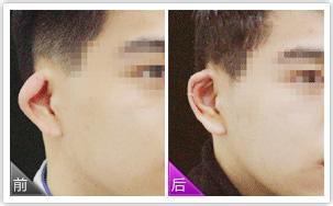 杯狀耳怎么矯正 杯狀耳矯正術(shù)的適應(yīng)癥