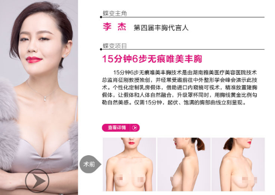 進(jìn)口膨體,進(jìn)口豐胸