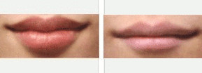 如何讓嘴唇變薄