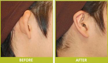 招風耳矯正,術后,多久,可能,恢復