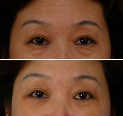 眉毛整形對(duì)比果照片圖