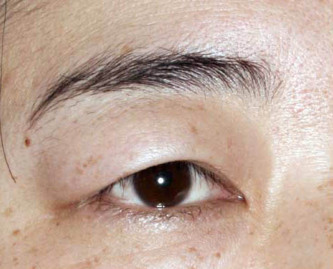 眉毛整形前后對比