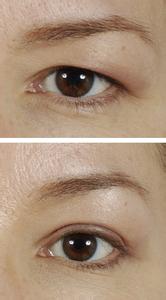 提眉切眉術(shù)前的注意事項