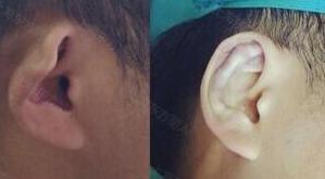 招風耳矯正,方式,有哪些