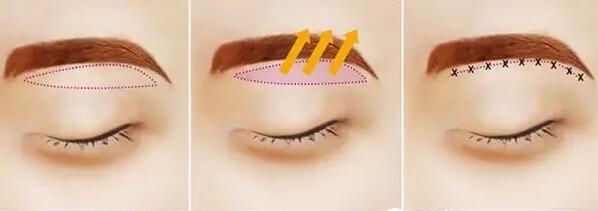 切眉手術(shù)前后對(duì)比照片