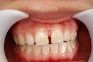 補(bǔ)牙縫,一般,需要,多少錢(qián)