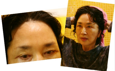 拉皮除皺手術(shù)讓我年輕20歲