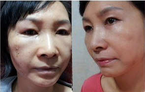 做了電波l皮除皺年輕了十多歲 杭州同欣做的很不錯(cuò)哦
