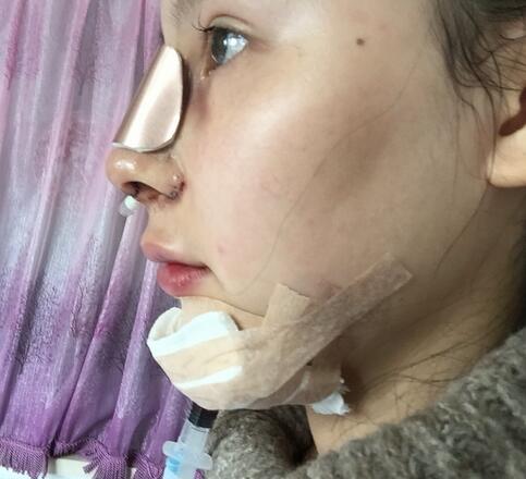 成都天使之翼做隆鼻整形改變了我的塌鼻子 果真的很不錯(cuò)