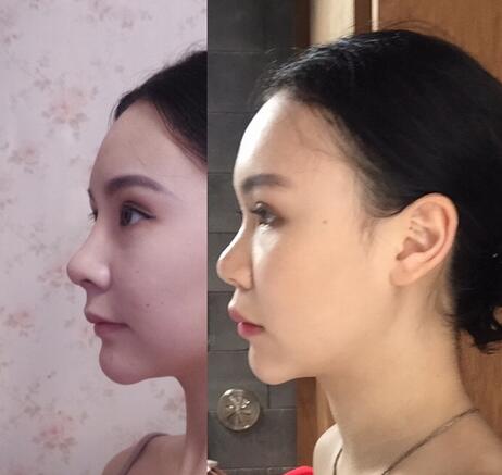 成都天使之翼做隆鼻整形改變了我的塌鼻子 果真的很不錯(cuò)