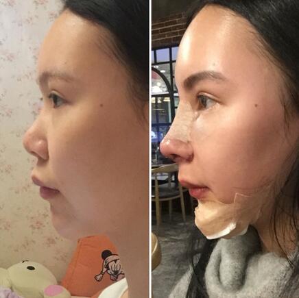成都天使之翼做隆鼻整形改變了我的塌鼻子 果真的很不錯(cuò)
