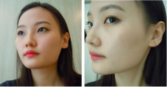 和大家分享北京301醫(yī)院做的下頜角整形真實(shí)經(jīng)