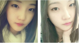 和大家分享北京301醫(yī)院做的下頜角整形真實(shí)經(jīng)