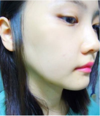 和大家分享北京301醫(yī)院做的下頜角整形真實(shí)經(jīng)