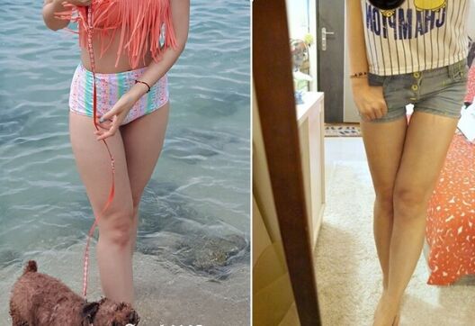 吸脂瘦大腿讓我變回纖纖細腿