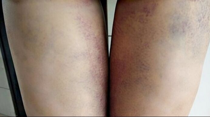 吸脂瘦大腿讓我變回纖纖細腿