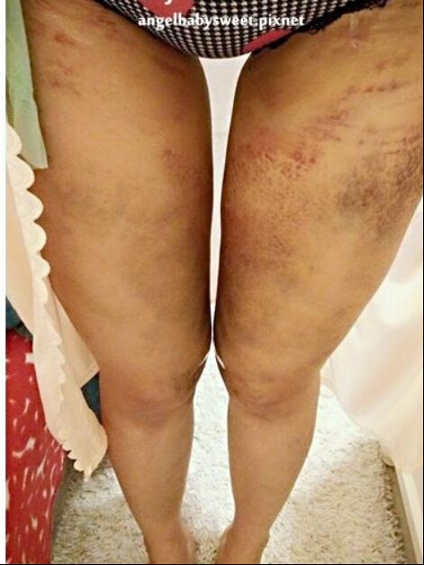 吸脂瘦大腿讓我變回纖纖細腿