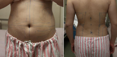 抽脂減肥瘦小腹 終于可以不用節(jié)食鍛煉了