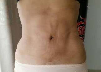 抽脂減肥瘦小腹 終于可以不用節(jié)食鍛煉了